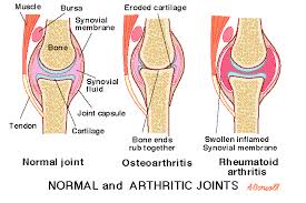 arthritis