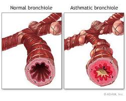 asthma