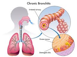 bronchitis