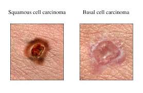 carcinoma