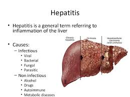 hepatitis