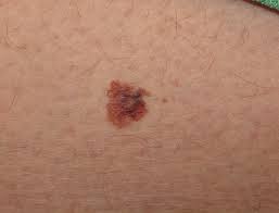 melanoma