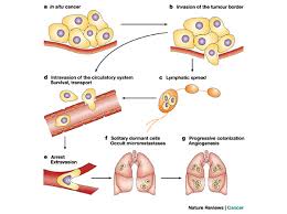 metastasis