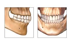 occlusion