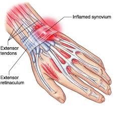 tendinitis