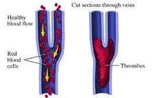 thrombosis